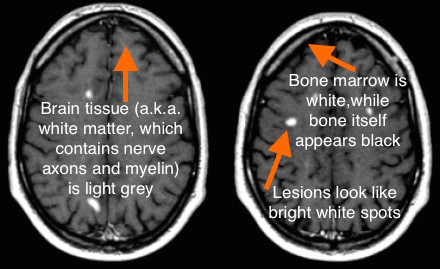 mri ms brain does look sclerosis multiple stephanie multiplesclerosis mris why when who