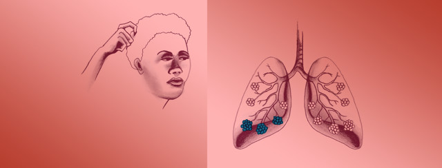 The Connection Between Pneumonia During Adolescence and MS image