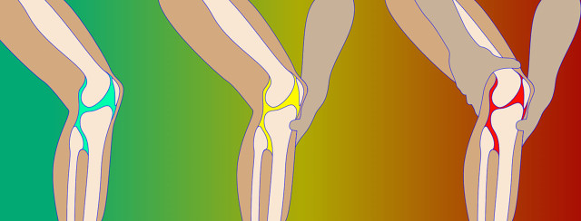 Considering Knee Replacement Surgery When Living with MS   image